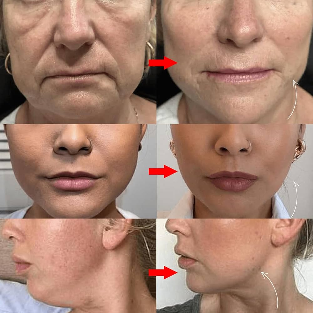 Dodo Lift — Máscara Reductora de Papada con Retinol y Colágeno